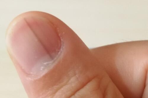 指甲上有豎紋是怎么回事？指甲上有黑線及手指甲上有豎紋怎么辦？