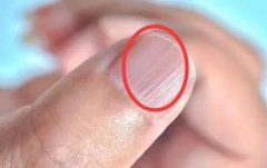 指甲上有豎紋是怎么回事？指甲上有黑線(xiàn)